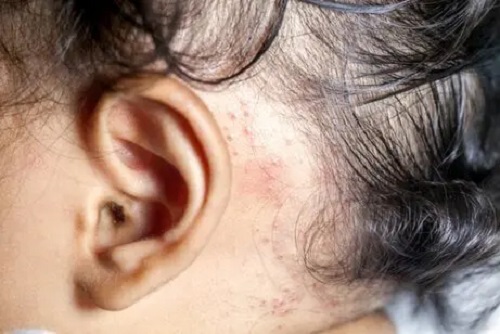 Psoriazisul la copii pe scalp