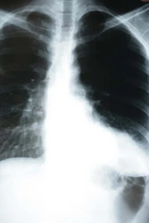 Rediografie făcută pentru a depista pneumonia silențioasă