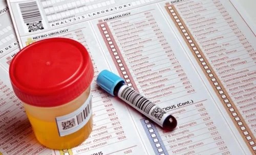 Schimbările la nivelul urinei evidențiate prin analize medicale