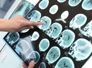 Tulburarea neurocognitivă majoră (demența)