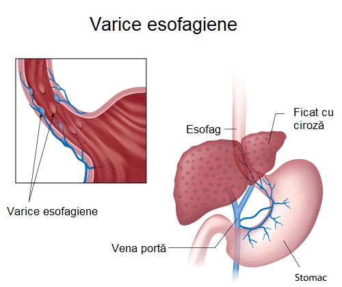 Simptomele varicelor esofagiene