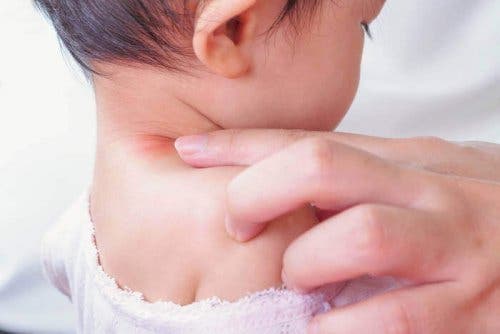 Bebeluș afectat de torticolisul muscular congenital
