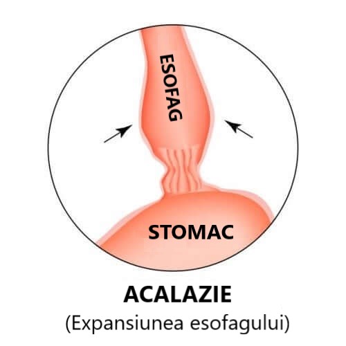 Deseun care ilustrează daunele produse de acalazia esofagiană