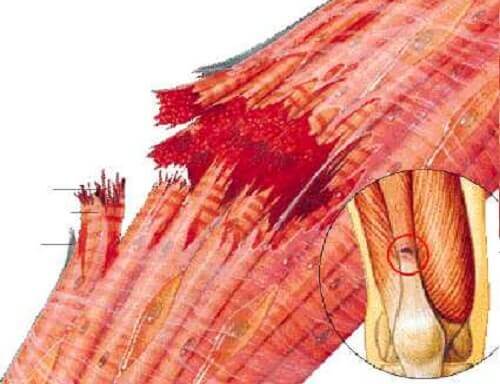 Desen ilustrând o fibră musculară ruptă