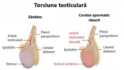 Torsiunea testiculară: și simptome Doza de
