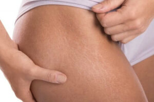 Cum să prepari o cremă antivergeturi cu vitamina E