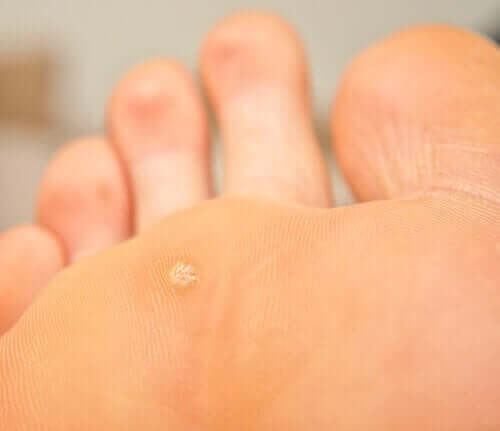 Neg plantar izolat