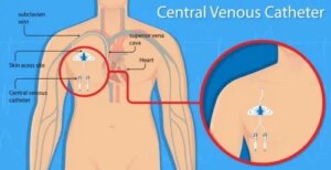 Perforația vasculară și cateterele venoase centrale