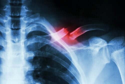 Radiografie ilustrând un os fracturat