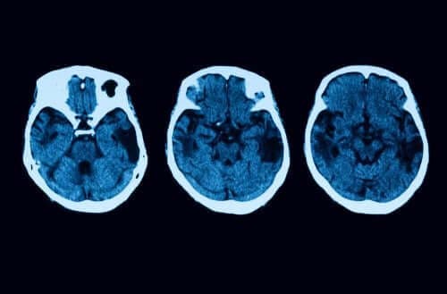 Atrofia corticală posterioară: diagnostic și tratament