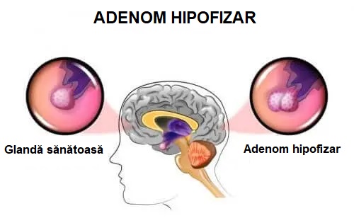 Cauzele și simptomele adenomului hipofizar