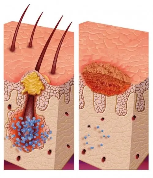 Sindromul de pilomatrixom multiplu exemplificat