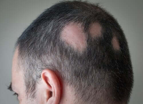 Bărbat care are nevoie de un tratament pentru alopecie cu minoxidil