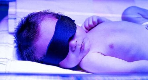 Bebeluș tratat cu fototerapie