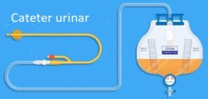 Tratament pentru retenția urinară postpartum