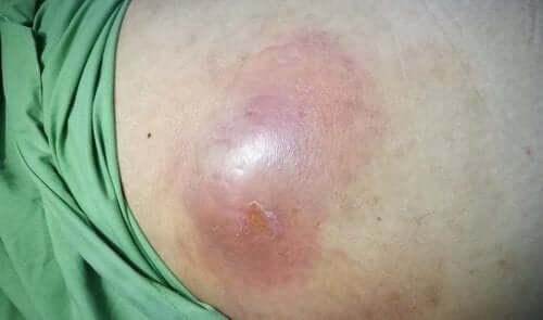 Ce sunt abcesele intraabdominale?