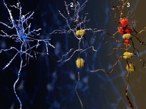Fazele maladiei Alzheimer la nivel neuronal