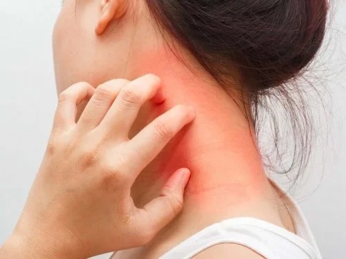 Femeie care simte ce este dermatita atopică