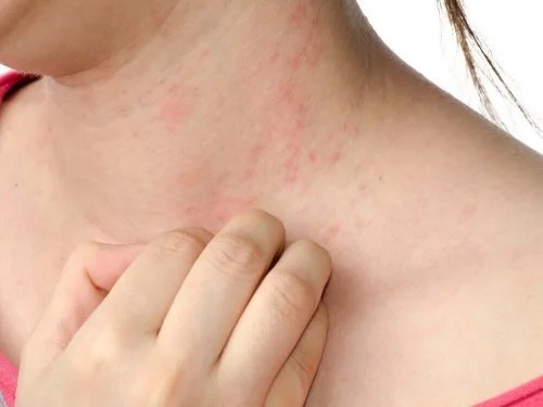 Femeie care are dermatită atopică