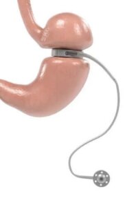 Inelul gastric ajustabil: utilizări și caracteristici