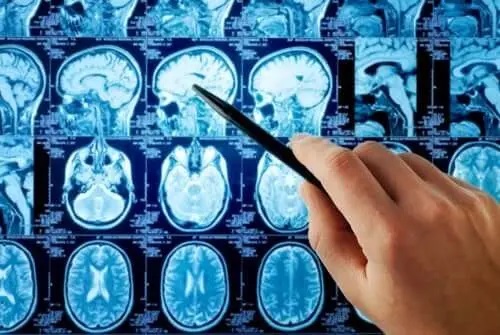 Medic care examinează un RMN cerebral