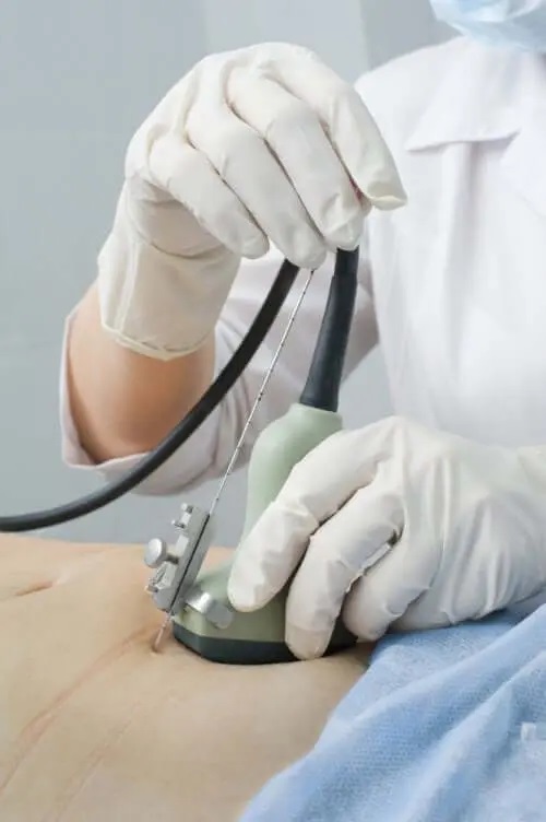 Medic care aplică unei paciente tratamente pentru adenomioză