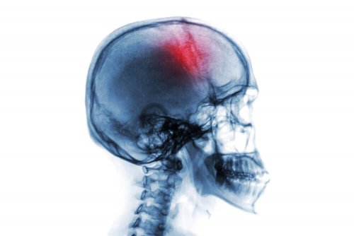 Radiografie ilustrând un craniu cu o zonă evidențiată în roșu