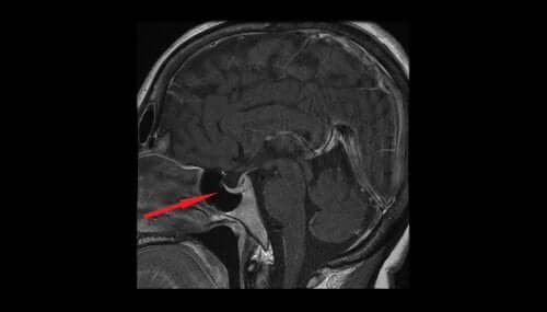 RMN arătând locația unui adenom hipofizar