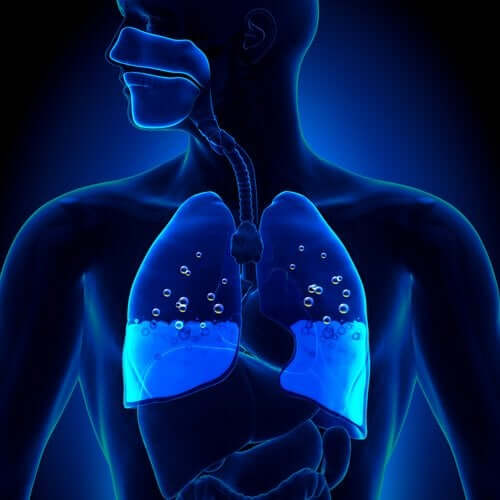 Cauze și simptome ale edemului pulmonar