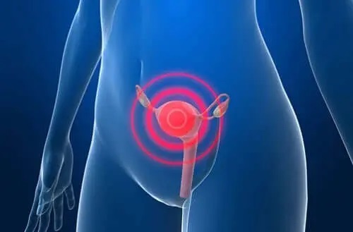 Nevoia de tratamente pentru adenomioză