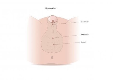 erecție după intervenția chirurgicală hipospadias)