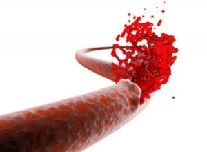 Cum se determină riscul de hemoragie postoperatorie?