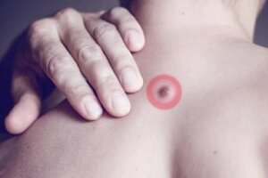 Nodulii de grăsime de pe spate: cauze