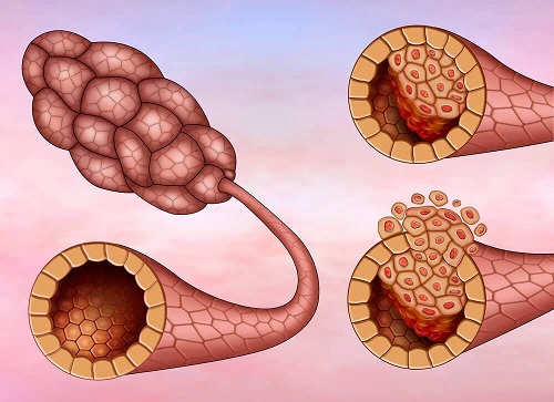 Carcinom ductal