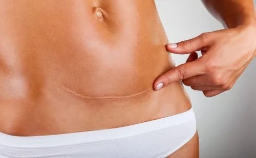 Operație de cezariană cu legarea trompelor uterine