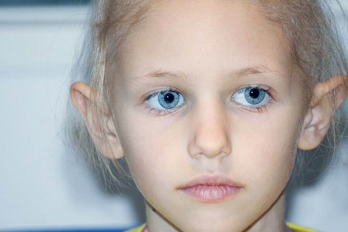 Copil prezentând simptomele retinoblastomului