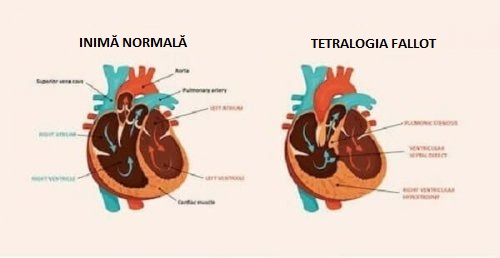 Desen ilustrând o inimă afectată de una dintre bolile cardiace congenitale