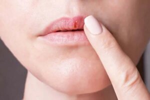 Virusul Herpes Simplex și caracteristicile sale