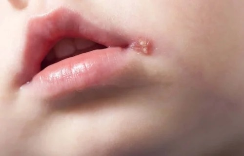 Herpes în colțul gurii