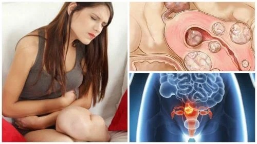 5 informații importante despre fibroza uterină