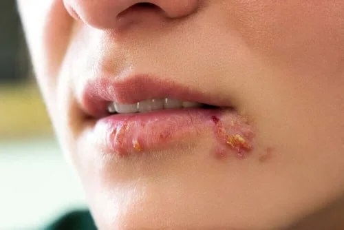 Leziune provocată de virusul Herpes Simplex