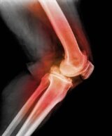 numele vătămării genunchiului osteochondroză antiinflamatoare nesteroidiene