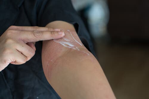 Pacient aplicând un corticosteroid topic pe o urticarie