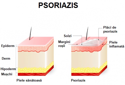Cum afectează psoriazisul pielea