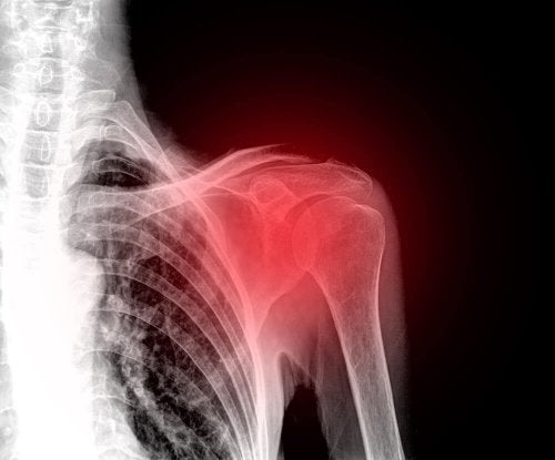 Radiografie ilustrând rutpura de coafă rotatorilor