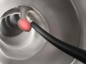 Caracteristici și simptome ale polipilor colorectali