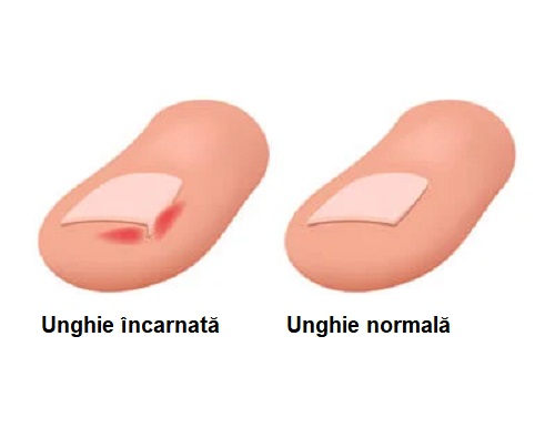 Unghie încarnată și unghie normală