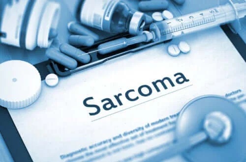 Caracteristicile și cauzele apariției sarcomului