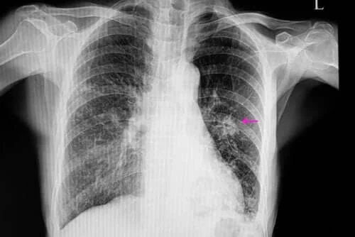 Ce este un nodul pulmonar și de ce apare?