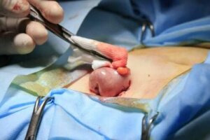 Ce este colostomia? Câteva informații de bază
